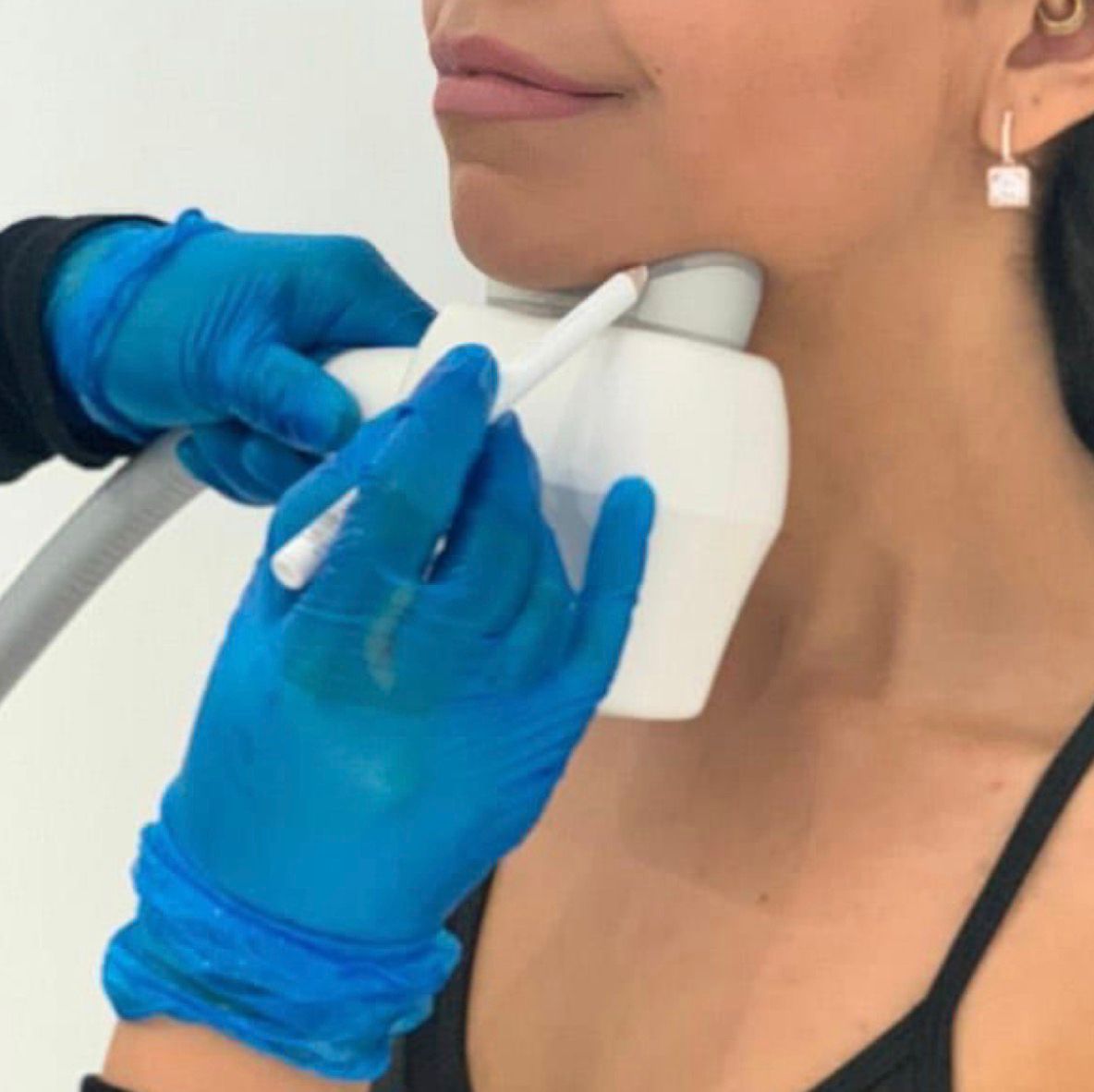 Chin coolsculpting